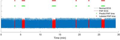 Premature Beats Rejection Strategy on Paroxysmal Atrial Fibrillation Detection